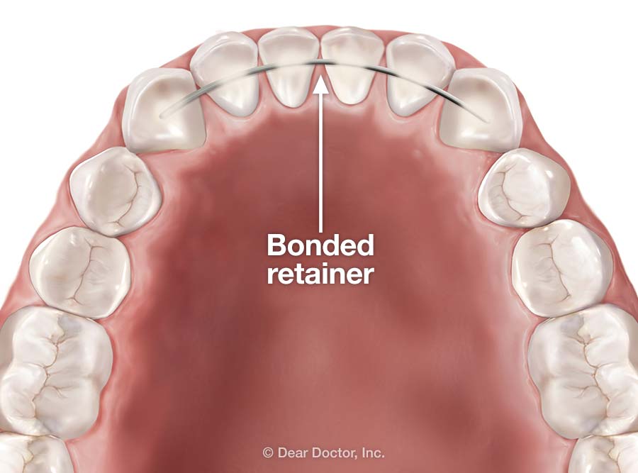 lingual retainer wire pack of 10